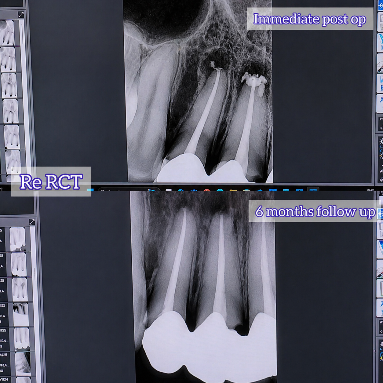 Root Canal Treatment